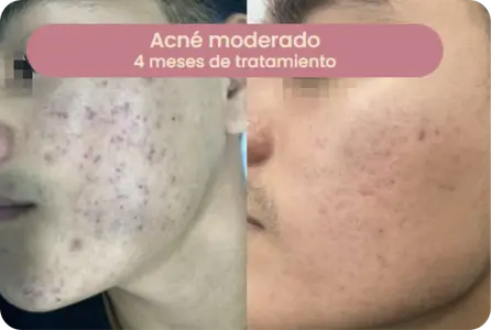 Caso de acné moderado — 4 meses de tratamiento