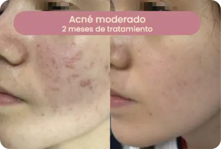 Caso de acné moderado — 2 meses de tratamiento
