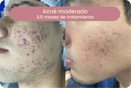 Caso de acné moderado — 1 mes de tratamiento