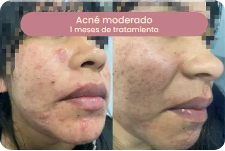 Caso de acné moderado — 3,5 meses de tratamiento