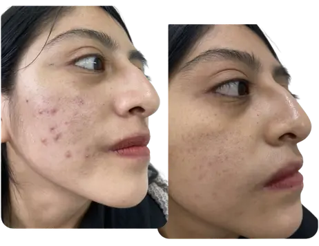 Antes y después del tratamiento de acné