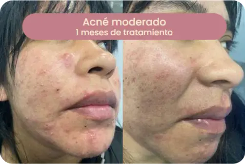 Caso de acné moderado — 3,5 meses de tratamiento