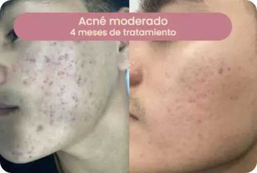 Caso de acné moderado — 4 meses de tratamiento
